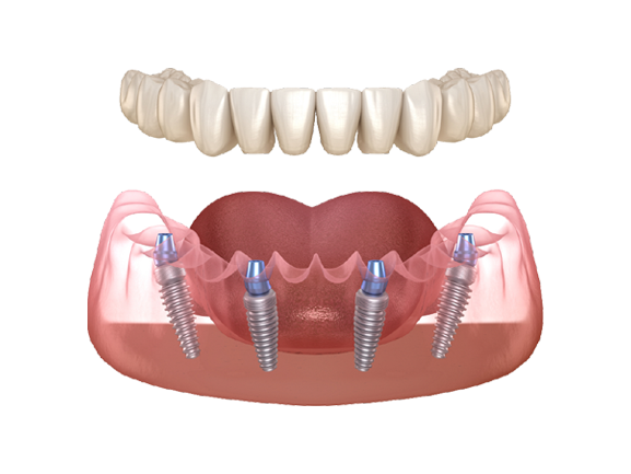 full-tooth-implant