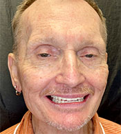 Bill-after